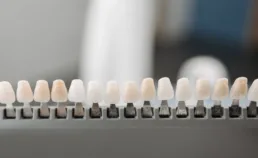 Ceramique dentaire capdentaire : quels avantages et pourquoi choisir cette solution ?